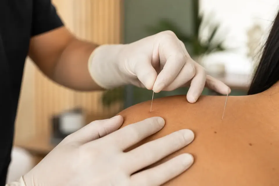 Dry needling therapy at Jones Chiropractic Clinic