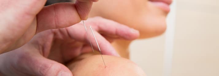 Dry Needling in Johnson City TN Dry Needling in Johnson City TN